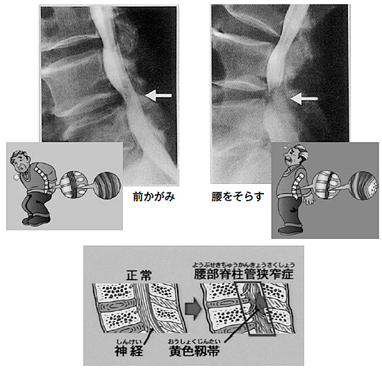 腰の動きと狭窄の程度（脊髄造影の側面像）