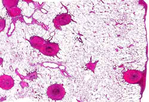 Silicotic nodule